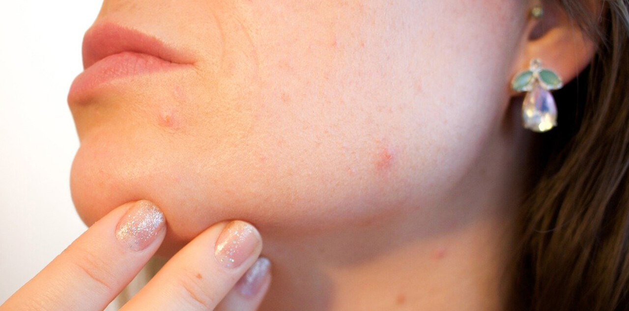 Does Biotin Cause Acne?